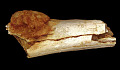 Volume rendered image of the external morphology of the foot bone shows the extent of expansion of the primary bone cancer beyond the surface of the bone. Patrick Randolph-Quinney (UCLAN)